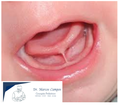 Foto Anquiloglossia