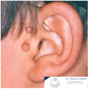 Foto ApÊndice Pré-Auricular