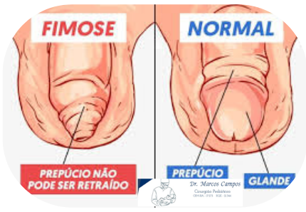Foto Fimose