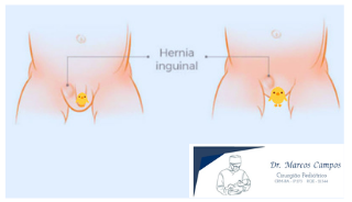 Foto Hérnia Inguinal