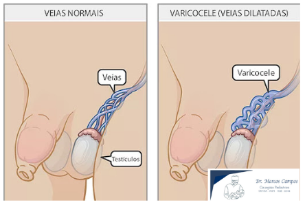 Foto Varicocele